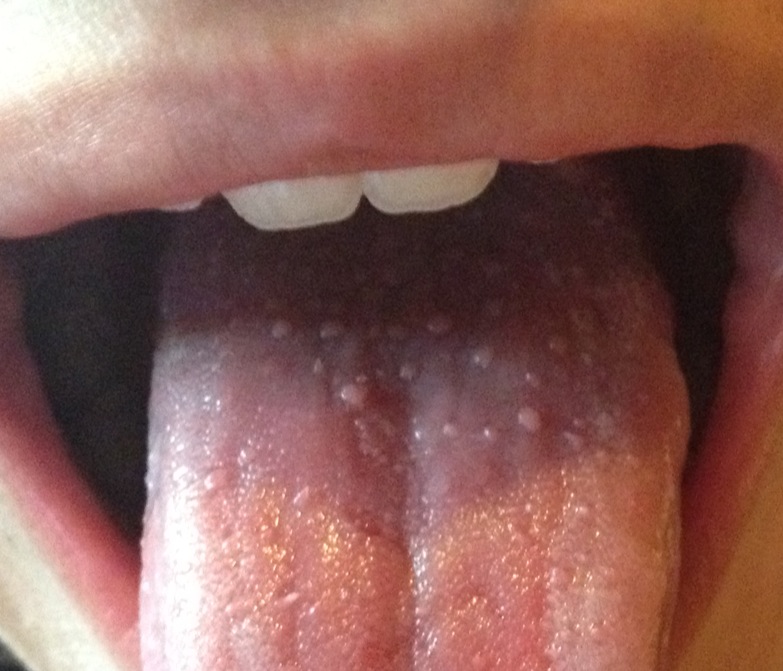 Sore Throat And White Lumps On Tongue