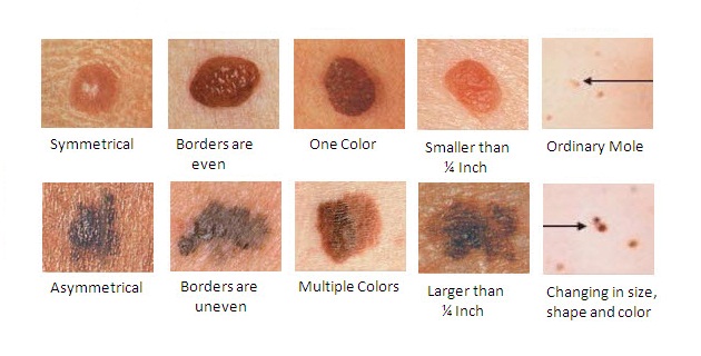 Small Red Moles On Skin Everything You Need To Know