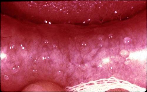 Bump On Roof Of Mouth Possible Causes And Medical Suggestions   Bump On The Roof Of The Mouth 